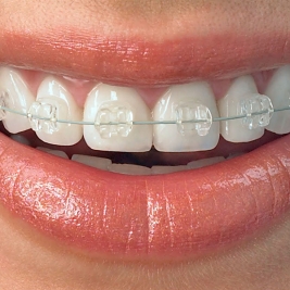 Clear Braces Service in Green Hills