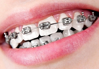 Conventional Dental Braces Service in Green Hills