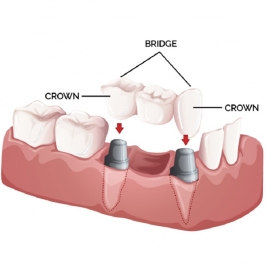 Dental Crowns and Bridges Service in Tenambit