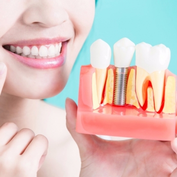 Dental Implants Service in Chisholm