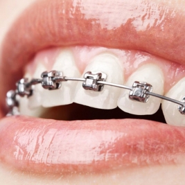 Metal Braces Service in Woodberry