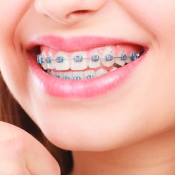 Orthodontics Service in Tarro