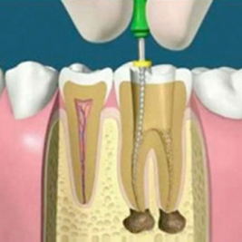 Root Canal Treatment Service in Metford