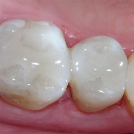 White Fillings Service in Tenambit