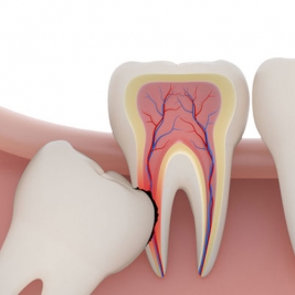 Wisdom Teeth Surgery Service in Beresfield